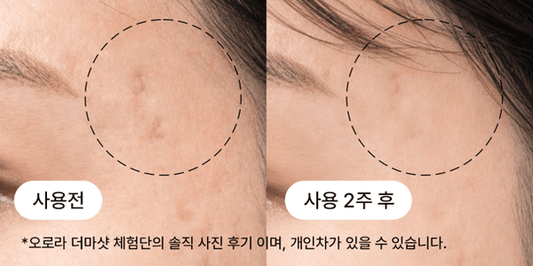 10,20대 여드름 흉터 개선 비포애프터