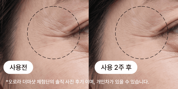 50,60대 눈가 주름 탄력 개선 비포애프터