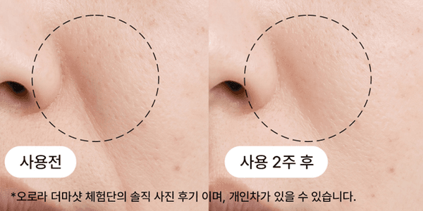40대 팔자 주름 개선 비포애프터
