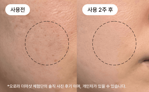 30대 모공 조임 개선 비포애프터